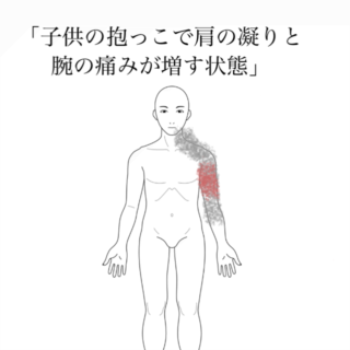 鍼灸の症例「「子供の抱っこで肩の凝りと腕の痛みが増す状態」」（清澄白河）