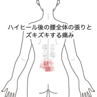 鍼灸の症例「ハイヒール後の腰全体の張りとズキズキする痛み」(JR品川駅/東京都品川区)