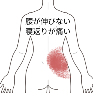 鍼灸の症例「立ち上がった瞬間にぐきっとした腰」(名鉄桜井駅/愛知県安城市)