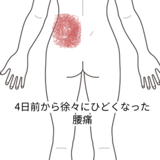 鍼灸の症例「動けないほどの腰痛とお尻の痛み」(名鉄桜井駅/愛知県安城市)