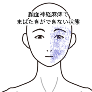 鍼灸の症例「顔面神経麻痺でまばたきができない状態」(JR品川駅/東京都品川区)