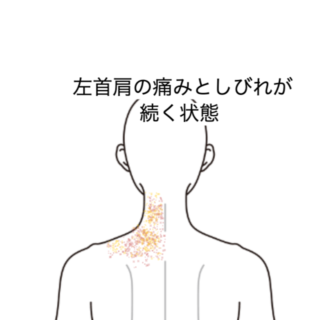 鍼灸の症例「左首肩の痛みとしびれが続く状態」(JR品川駅/東京都品川区)