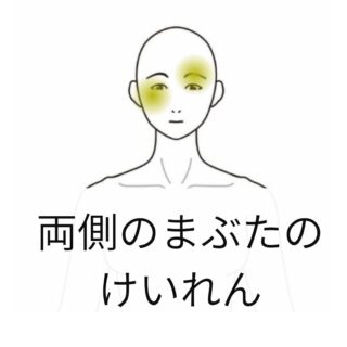 鍼灸の症例「両側のまぶたのけいれん」(世田谷区 三軒茶屋駅)