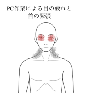 鍼灸の症例「PC作業で悪化する目の疲れと首の緊張」(清澄白河)