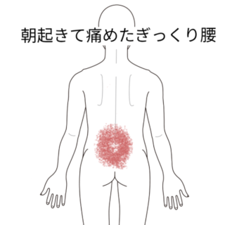 鍼灸の症例「朝起きて痛めたぎっくり腰」(勝田駅)
