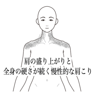 鍼灸の症例「肩の盛り上がりと全身の硬さが続く慢性的な肩こり」(都営新宿線 船堀駅 / 東京都江戸川区船堀)