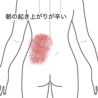 鍼灸の症例「朝の起き上がりや歩行時に痛む左腰の症状」(群馬県伊勢崎市)