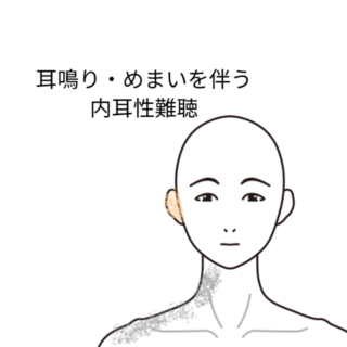 鍼灸の症例「耳鳴り・めまいを伴う内耳性難聴」(西武新宿線「本川越駅」徒歩5分 / 埼玉県川越市)