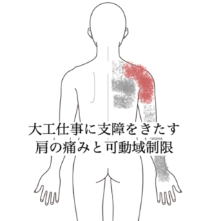 鍼灸の症例「大工仕事に支障をきたす肩の痛みと可動域制限」(都営新宿線 船堀駅 / 東京都江戸川区船堀)
