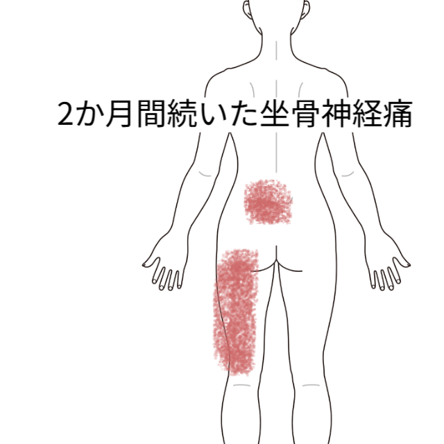 2か月間続いた坐骨神経痛｜坐骨神経痛、腰痛のツボ｜ツボネット 鍼灸の