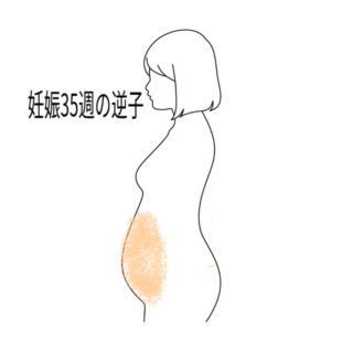 鍼灸の症例「妊娠35週の逆子」(愛知県あま市 / 名鉄七宝駅)