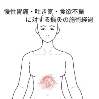 鍼灸の症例「慢性胃痛・吐き気・食欲不振に対する鍼灸の施術効果」(西武新宿線「本川越駅」徒歩5分 / 埼玉県川越市)