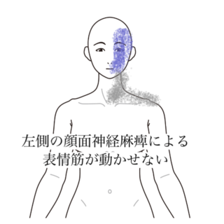 鍼灸の症例「表情筋が動かない左顔面の麻痺症状」(清澄白河)