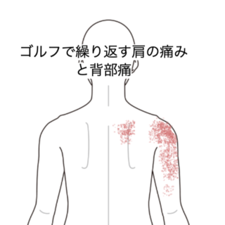 鍼灸の症例「ゴルフで繰り返す肩の痛みと背部痛」(JR品川駅/東京都品川区)