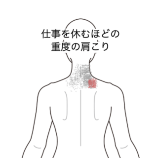 鍼灸の症例「仕事を休むほどの重度の肩こり」(JR品川駅/東京都品川区)