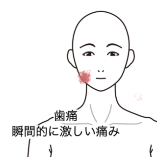 鍼灸の症例「「突発性神経痛」と診断された食後に悪化する歯の激痛」(群馬県伊勢崎市)