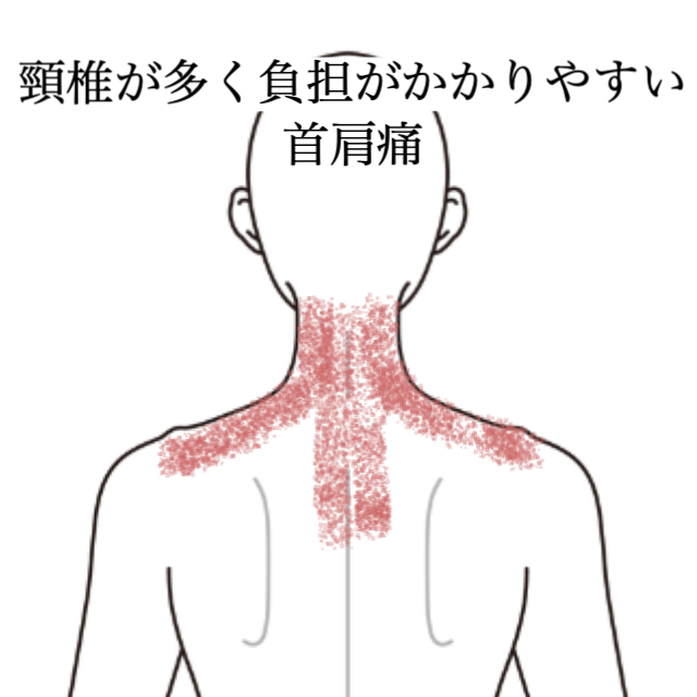 頸椎の形態異常による慢性的な首肩こり｜頚痛、肩こり・首こりのツボ