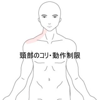 鍼灸の症例「長距離運転で悪化した頸部の痛みとコリ」（東室蘭駅）