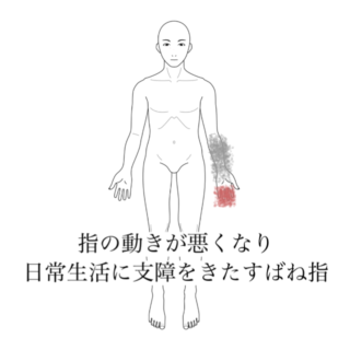 鍼灸の症例「指の動きが悪くなり日常生活に支障をきたす中指痛」(清澄白河)