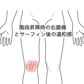 鍼灸の症例「階段昇降時の右膝痛とサーフィン後の違和感」（JR品川駅／東京都品川区）