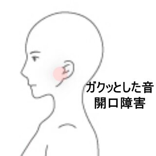 鍼灸の症例「硬いものを食べた後の顎関節音と開口障害」(東室蘭駅)