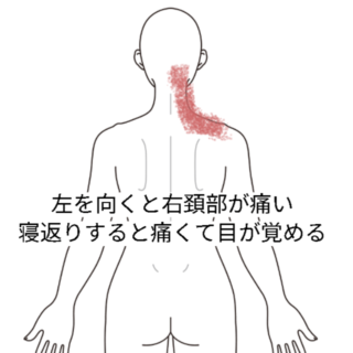 鍼灸の症例「横になると首が痛い」（阪急高槻駅/大阪府高槻市・茨木市・枚方市・京都・滋賀）