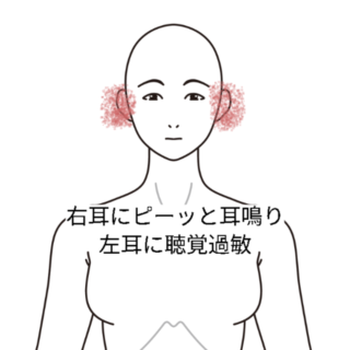 鍼灸の症例「耳鳴りと聴覚過敏」(阪急高槻駅/大阪府高槻市・茨木市・枚方市・京都・滋賀)