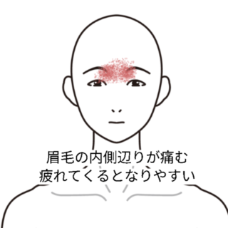鍼灸の症例「眉間からの頭痛」(阪急高槻駅/大阪府高槻市・茨木市・枚方市・京都・滋賀)