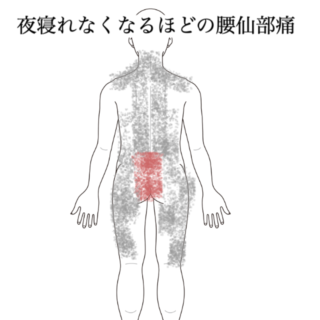 鍼灸の症例「夜も眠れないほどの腰と仙骨の痛み」(都営新宿線 船堀駅 / 東京都江戸川区船堀)