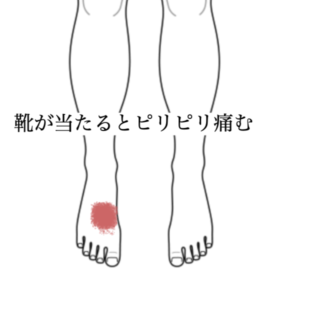 鍼灸の症例「靴が当たると足の甲がピリピリ痛む」（神戸市須磨区）