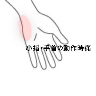 鍼灸の症例「物を持つと痛む小指と手首の痛み」（東室蘭駅）