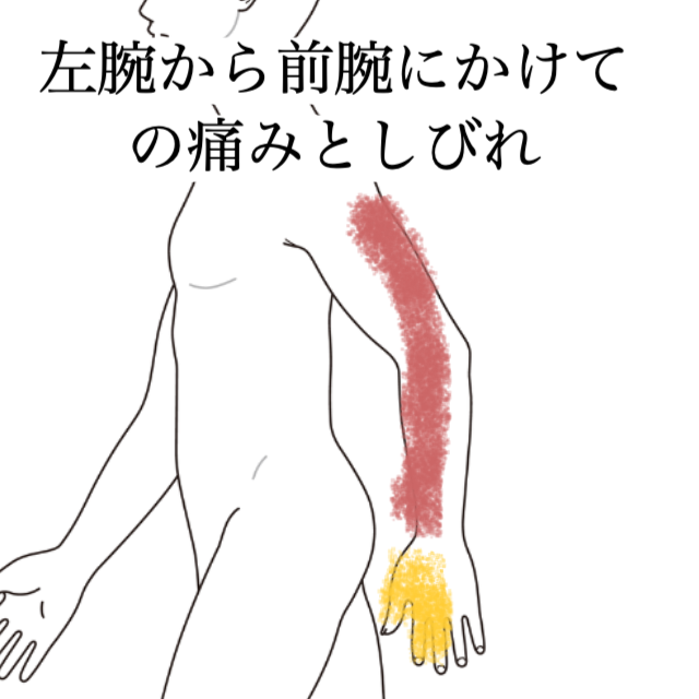 左腕から前腕にかけての痛みとしびれが軽減した症例｜腕の重だるさ、腕