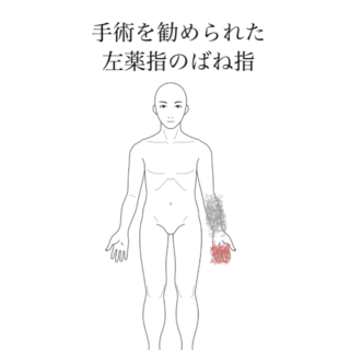 鍼灸の症例「手術を勧められた左薬指のばね指」（清澄白河）