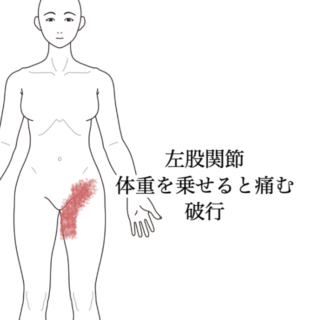 鍼灸の症例「歩きすぎによる左股関節痛」(神戸市須磨区)