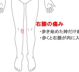 鍼灸の症例「歩き始める時だけ右膝が痛む」(小田急線秦野駅/神奈川県秦野市)