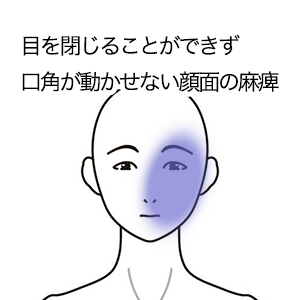 鍼灸の症例「目を閉じることができず口角が動かせない顔面の麻痺」（西武新宿線「本川越駅」徒歩5分　/　埼玉県川越市）
