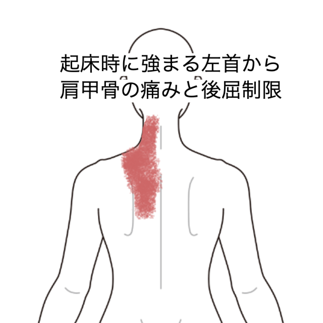 起床時に強まる左首から肩甲骨の痛みと後屈制限｜頚痛のツボ｜ツボ