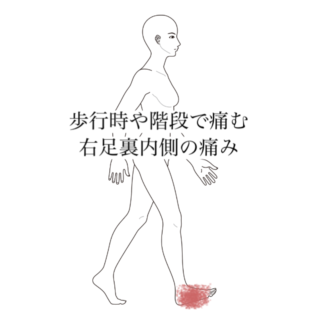 鍼灸の症例「歩行時や階段で痛む右足裏内側の痛み」（清澄白河）