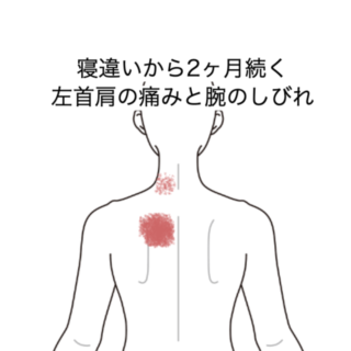鍼灸の症例「寝違いから2ヶ月続く左首肩の痛みと腕のしびれ」（JR品川駅／東京都品川区）