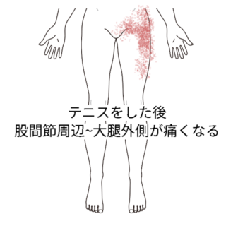 鍼灸の症例「テニスをした後に股関節周辺が痛くなる」（阪急高槻駅/大阪府高槻市・茨木市・枚方市・京都・滋賀）