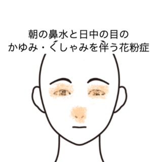 鍼灸の症例「朝の鼻水と日中の目のかゆみ・くしゃみを伴う花粉症」（JR品川駅／東京都品川区）