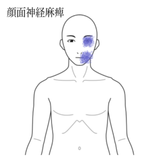 鍼灸の症例「顔面神経麻痺による目が閉じにくく口が引きつる症状」（有松駅）