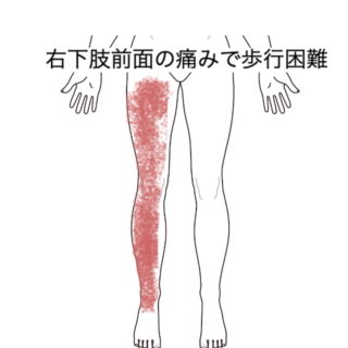 鍼灸の症例「右下肢前面の痛みで歩行困難」（JR品川駅／東京都品川区）