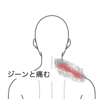鍼灸の症例「取り憑かれたような首肩こり」（群馬県伊勢崎市）