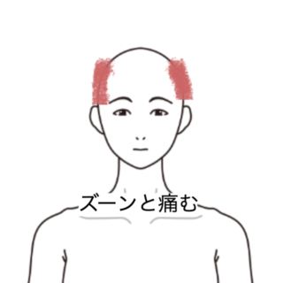 鍼灸の症例「こめかみと耳周辺に広がる頭痛」（群馬県伊勢崎市）
