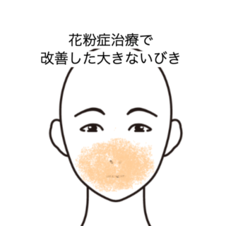 鍼灸の症例「花粉症治療で改善した大きないびき」（JR品川駅／東京都品川区）