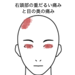 鍼灸の症例「右頭部の重だるい痛みと目の奥の痛み」（JR品川駅／東京都品川区）
