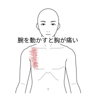 鍼灸の症例「腕を挙げると胸が痛い」（阪急高槻駅/大阪府高槻市・茨木市・枚方市・京都・滋賀）