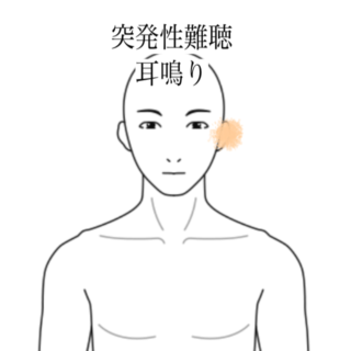 鍼灸の症例「突発性難聴による左耳の聴力低下と耳鳴り」（有松駅）