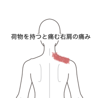 鍼灸の症例「荷物を持つと痛む右肩の痛み」（JR品川駅／東京都品川区）